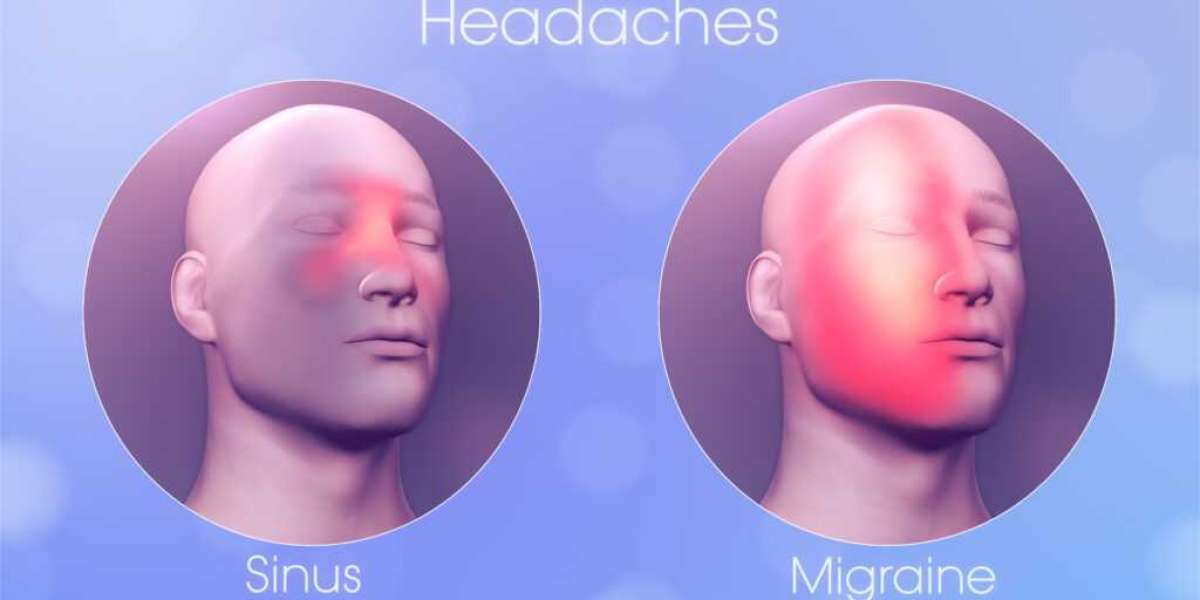 Sinus Headaches vs. Migraines: How to Get the Right Diagnosis