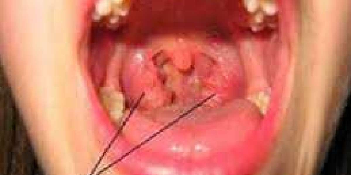 Tonsillitis in Children: A Parent's Complete Guide