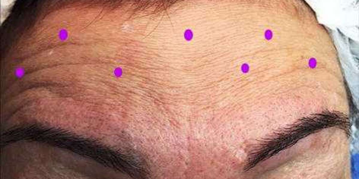 Die wichtigsten Vorteile von Micro Baby Botox für Erstanwender