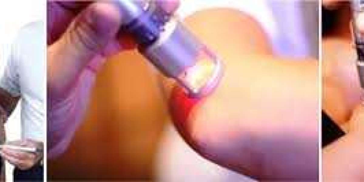 K-Laser Therapy Near Me: Heal Naturally at Nicali Sports Medicine